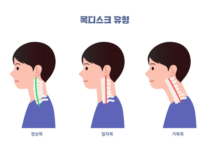 대구목디스크한의원 거북목 손 저림 전 나타나는 뒷목 뻣뻣함 신호